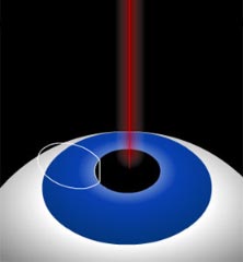 Lasik Laser Operation